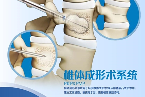 椎體成形術(shù)系統(tǒng) (PKP&PVP)
