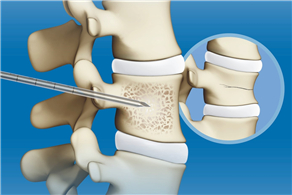 椎體成形術(shù)輔助器械彩頁